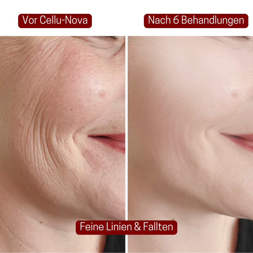CelluNova™ Micro Infusion System
