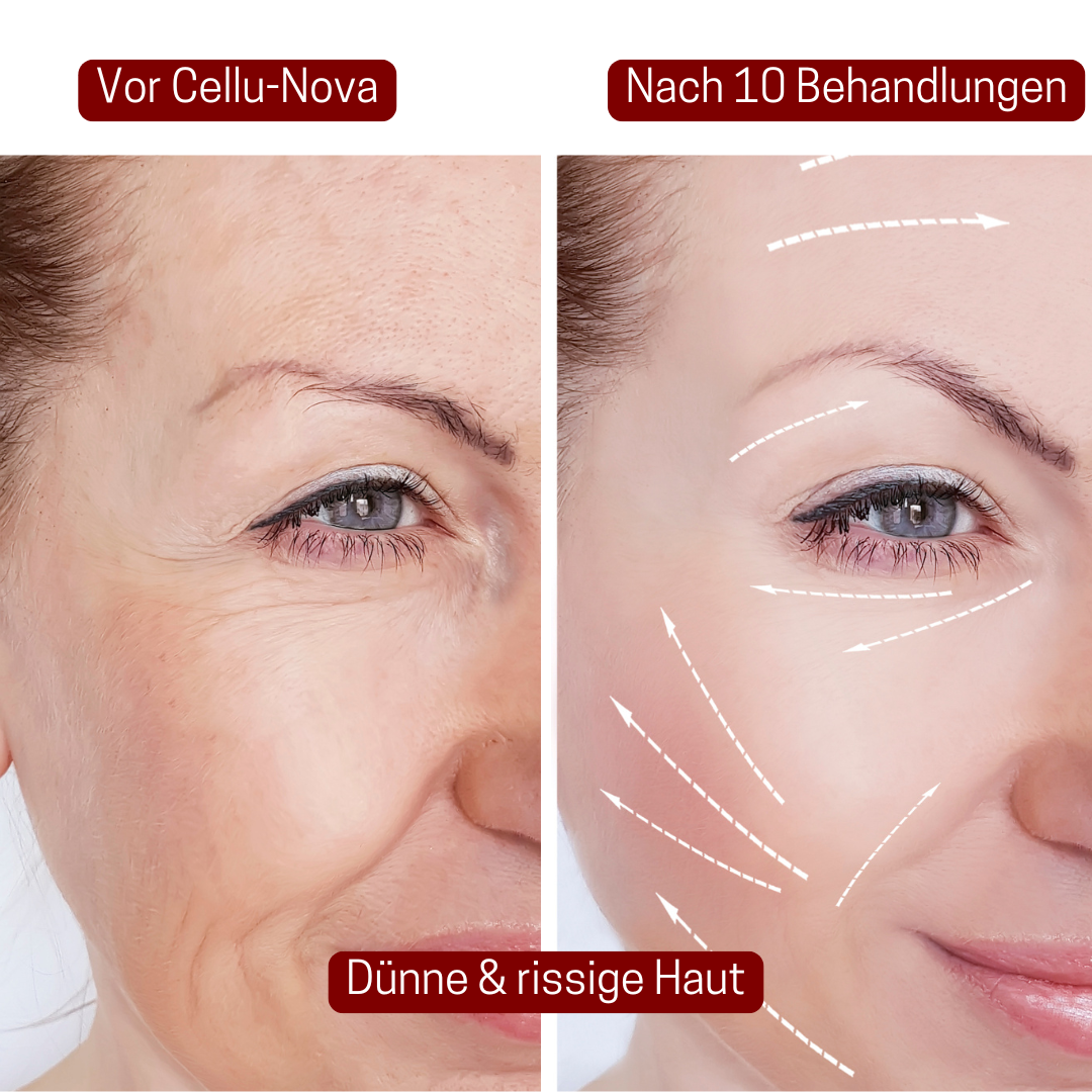 CelluNova™ Micro Infusion System